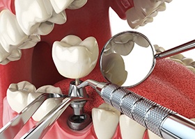 Parts of a dental implant in Rochester