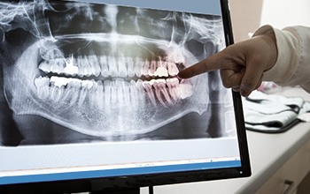 Dental x-rays on computer monitor