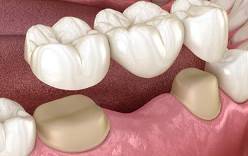 dentist and patient discussing types of dental bridges in Rochester
