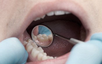 Closeup of patient during dental exam