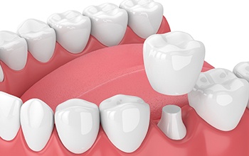 dental crown in Rochester