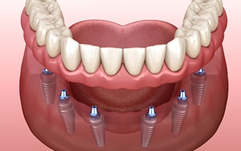 An implant-retained denture