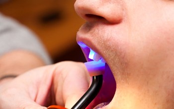 close up of man getting direct bonding hardened with curing light