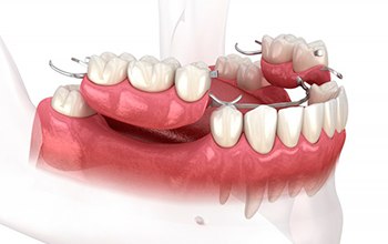 Illustration of partial denture