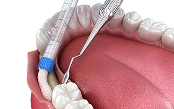 Woman getting dental surgery