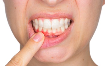 A woman pointing to red, inflamed gums