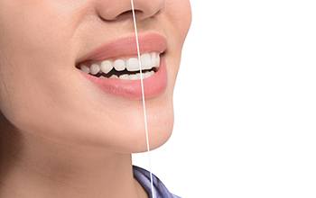 A model showing excess gum tissue before and after gum recontouring