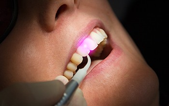 Dentist using soft tissue laser for gum recontouring procedure