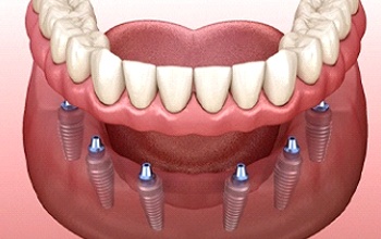 An implant denture in Rochester