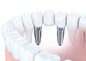 implant bridge