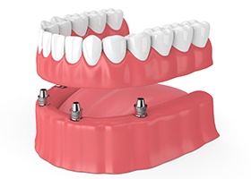 diagram of implant dentures in Rochester