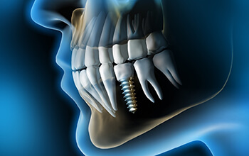 Diagram of X-ray of dental implants in Rochester