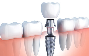 Diagram of dental implants in Rochester being placed