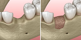 Diagram of bone grafting in Rochester