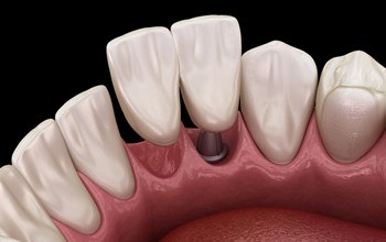 Dentures Bridges Implants  - Dental Implants And Bridges Both Offer An Excellent Solution To A Missing Tooth.