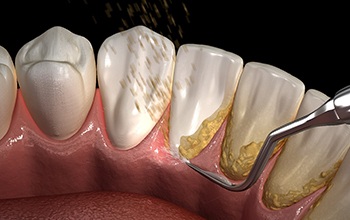 computer illustration of a scaler removing tartar buildup behind teeth