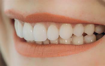 Closeup of woman smiling with veneers in Rochester