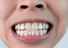 Stained teeth needing whitening treatment