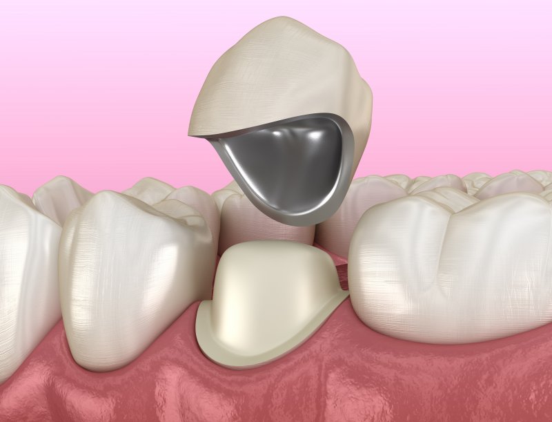Dental crown with a metal base going over a tooth