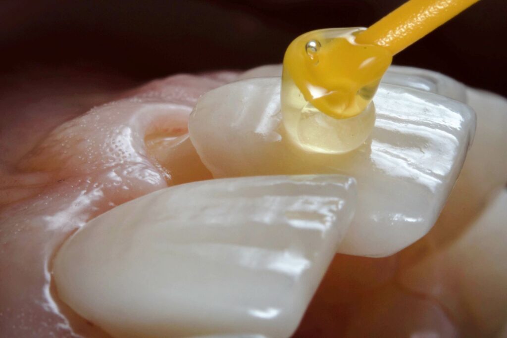 Closeup of veneer being cemented to front tooth