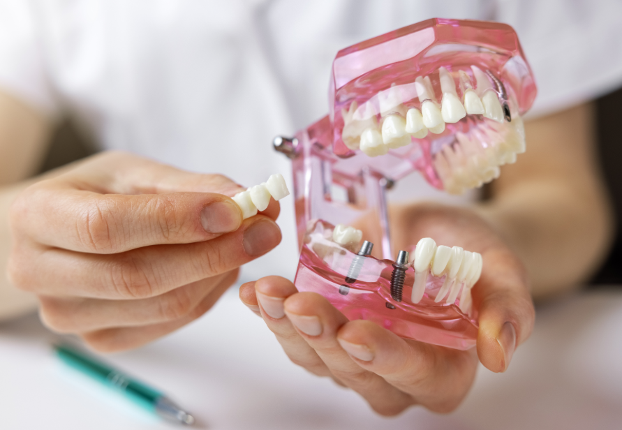 Plastic model of dental implants